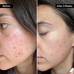 QRxLabs ingredientes activos 2% salicílico 10% glicólico y vitaminas para renovar piel