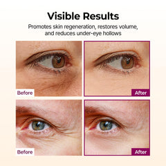 Dr.Melaxin aplicando bajo el ojo para rellenar hollines y suavizar líneas