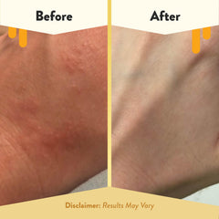 ECZEMA HONEY aplicación en brazo demostrando alivio inmediato