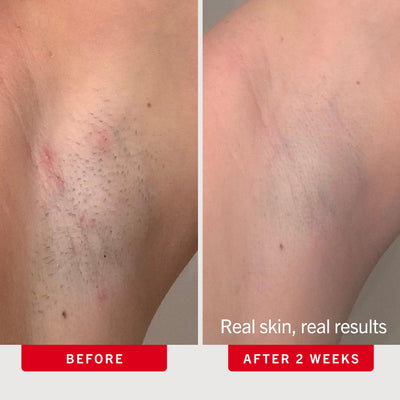 First Aid Beauty uso en línea del bikini para reducción de irritación
