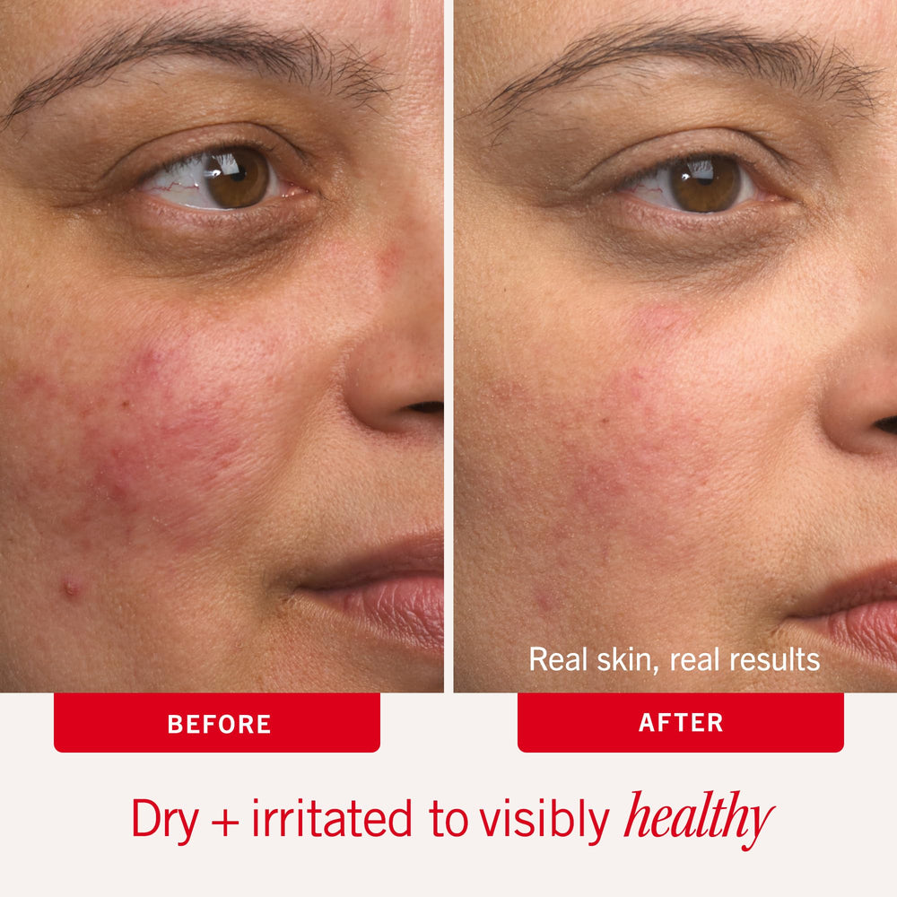 First Aid Beauty uso en rostro para suavizar y calmar la piel seca