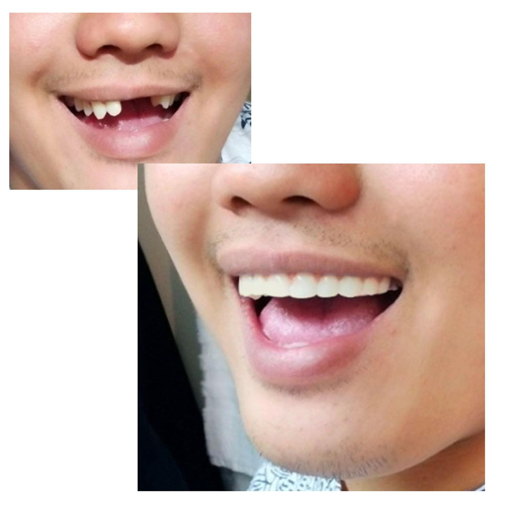 Instant Smile comparación de tamaño relativo con regla para referencia de ajuste