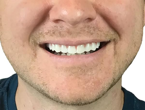 Instant Smile pieza colocada sobre dientes superiores para sonrisa más natural