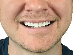 Instant Smile pieza colocada sobre dientes superiores para sonrisa más natural