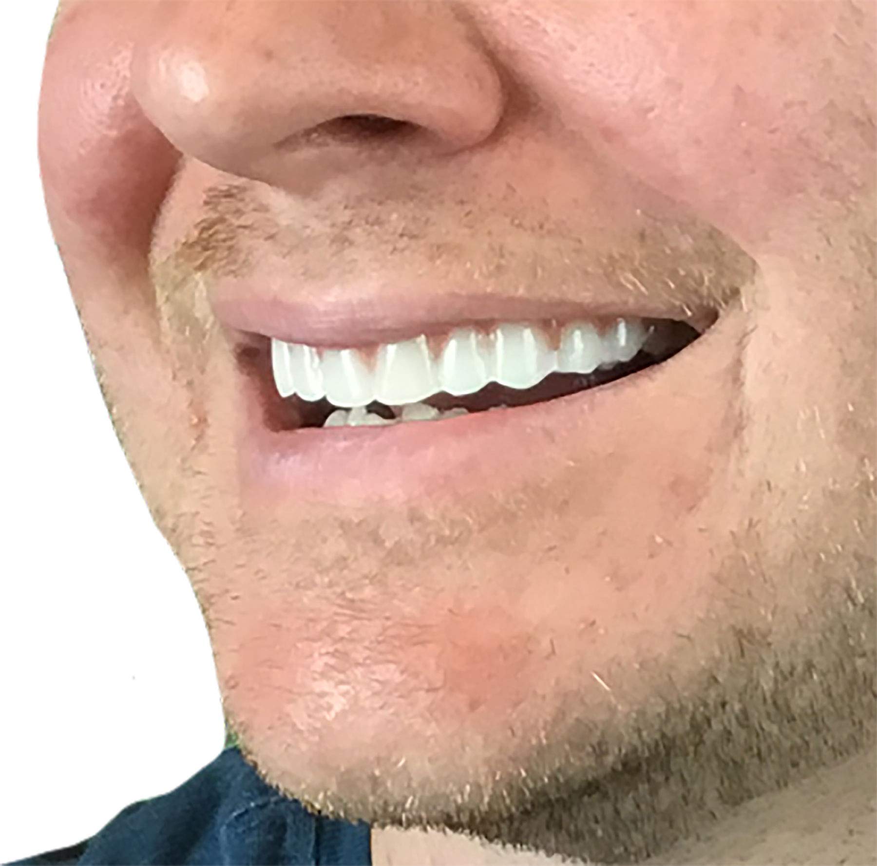 Instant Smile manos moldeando la prótesis en agua tibia para ajuste preciso