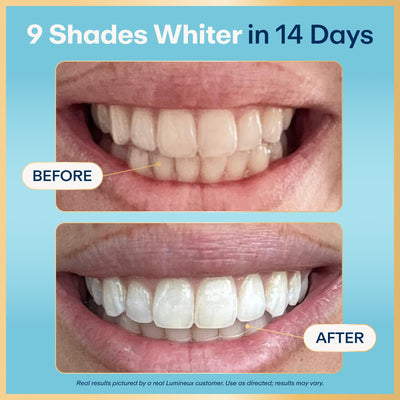 Lumineux whitening strip applied on teeth illustrating targeted stain lift