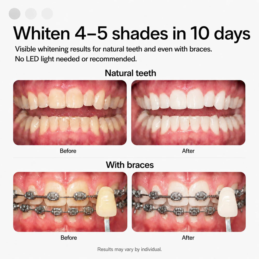 Opalescence trays in mouth demo illustrating simple 15–20 minute application benefit