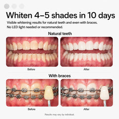 Opalescence trays in mouth demo illustrating simple 15–20 minute application benefit