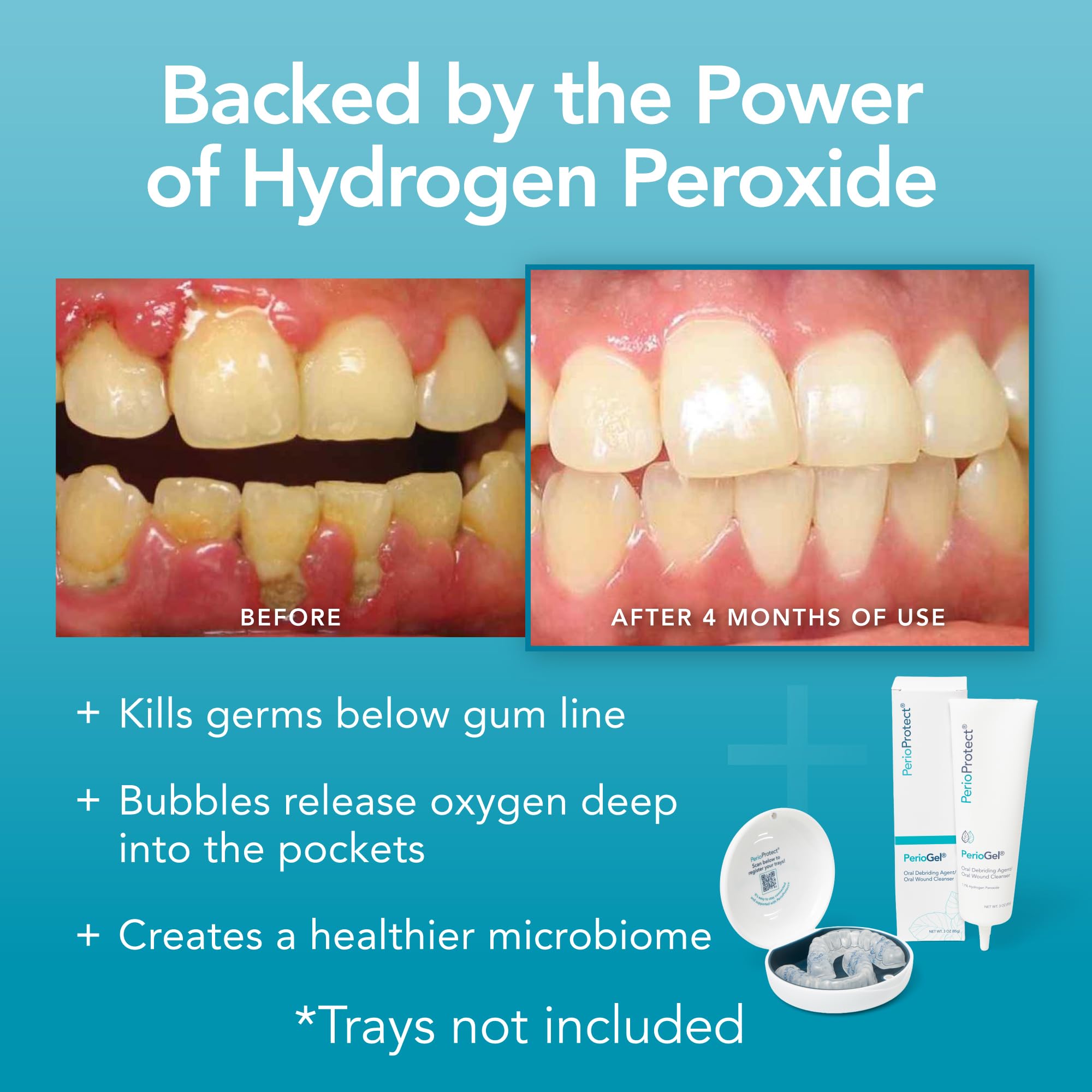 Perio Protect imagen de sonrisa antes y después mostrando mejora estética