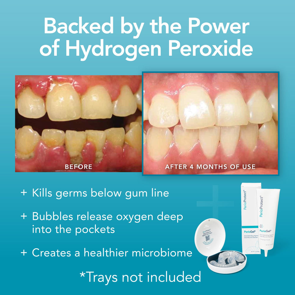 Perio Protect imagen de sonrisa antes y después mostrando mejora estética