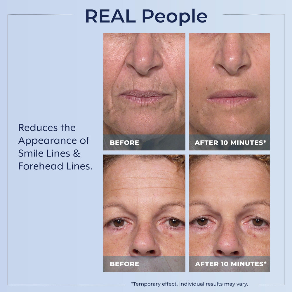 Plexaderm applied under-eye illustrating visible lift and refreshed look benefit