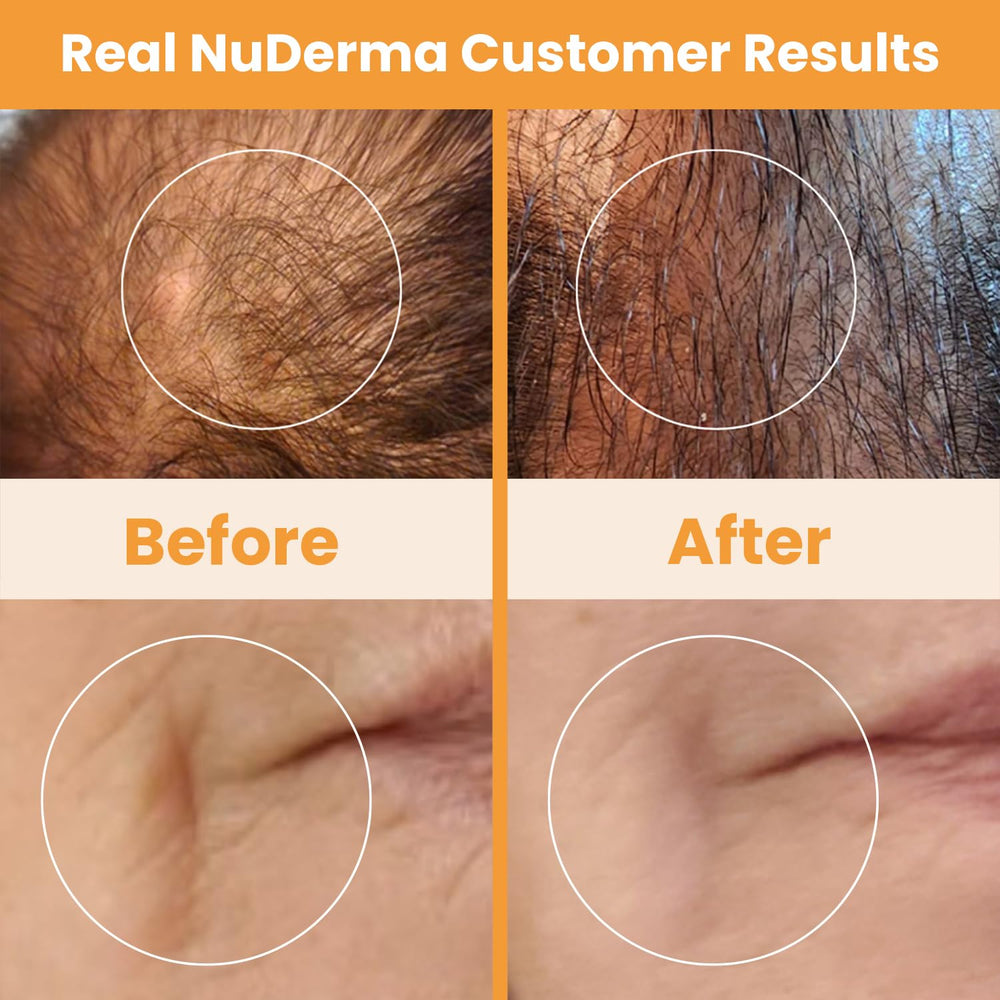 Pure Daily Care NuDerma box contents arrangement displaying device and four neon applicators
