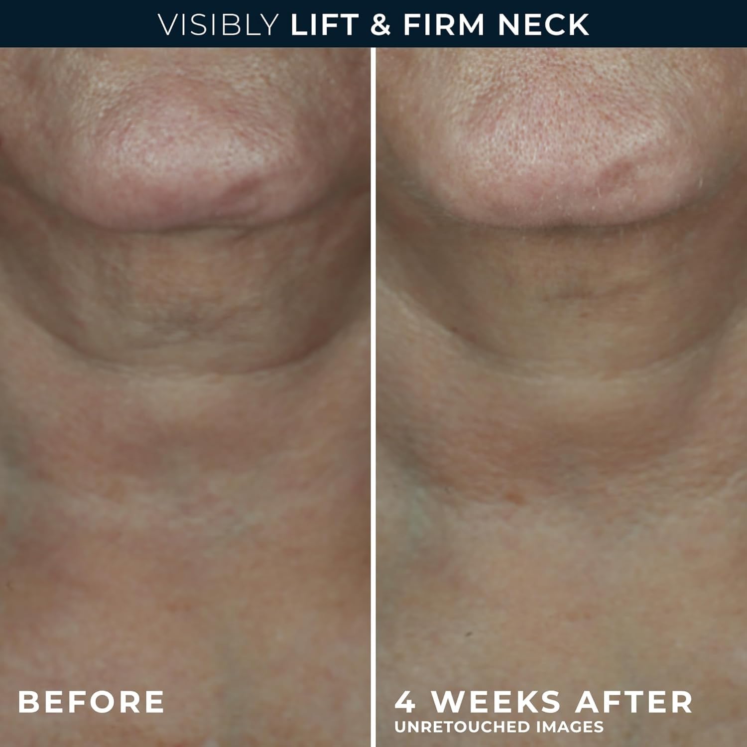 RoC aplicación en cuello y mandíbula demostrando uso correcto y elevación
