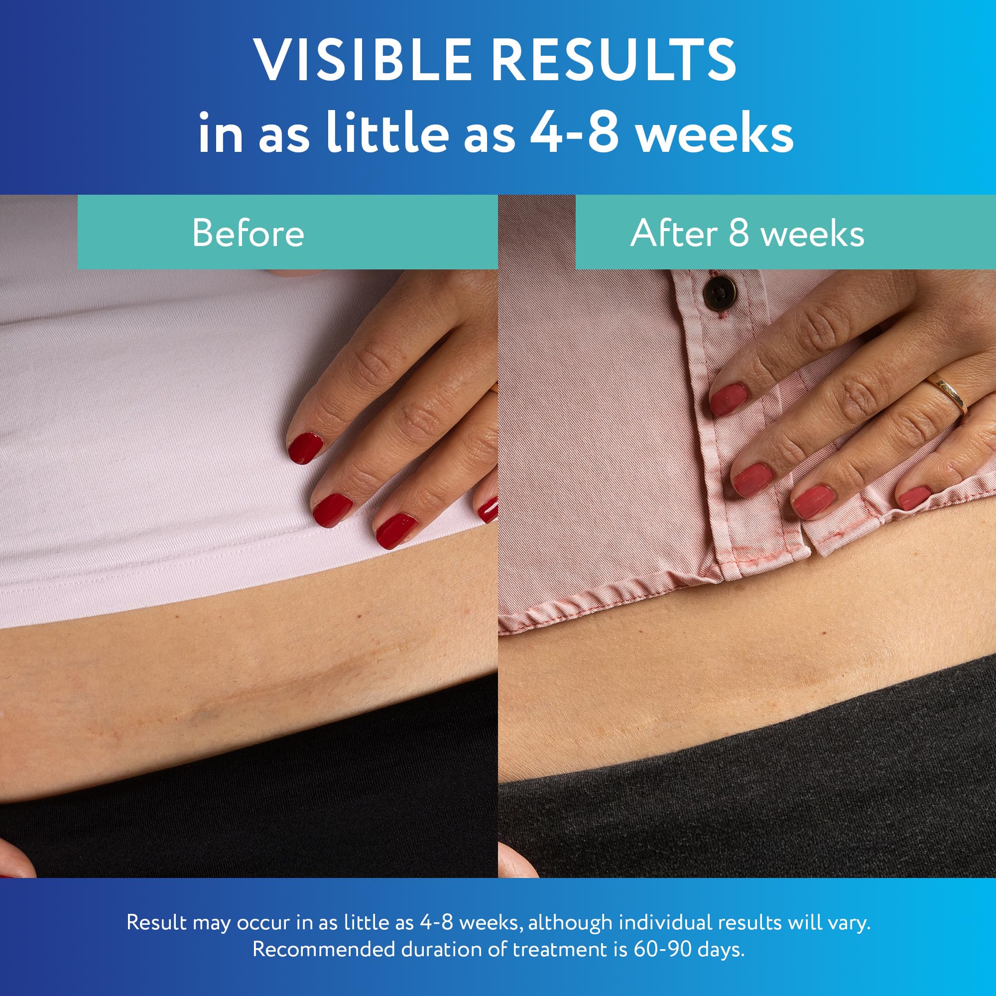 ScarAway sheet in use on forearm demonstrating discreet everyday wear