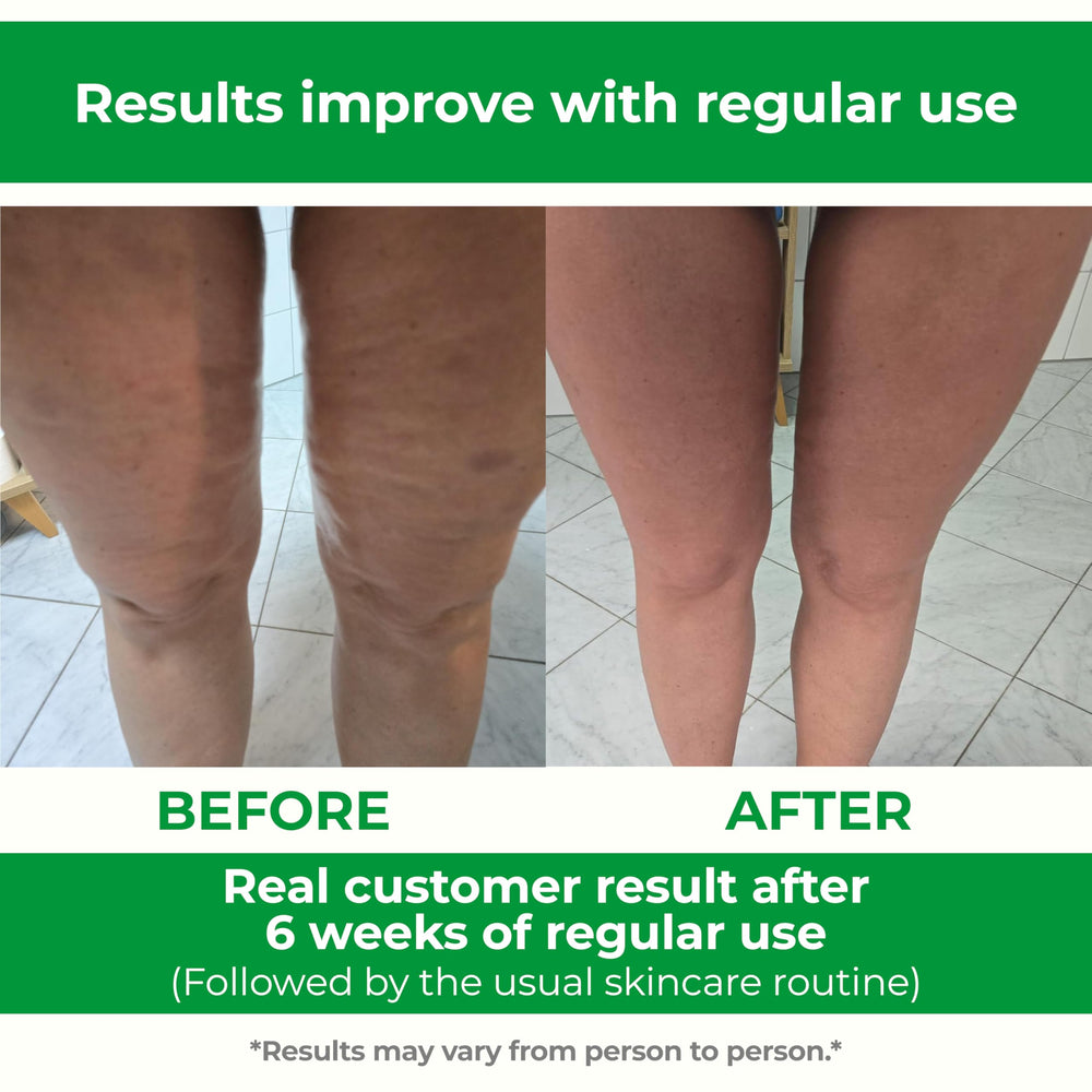 TESMED comparación de ancho ajustable hasta 38 cm para cubrir zonas grandes