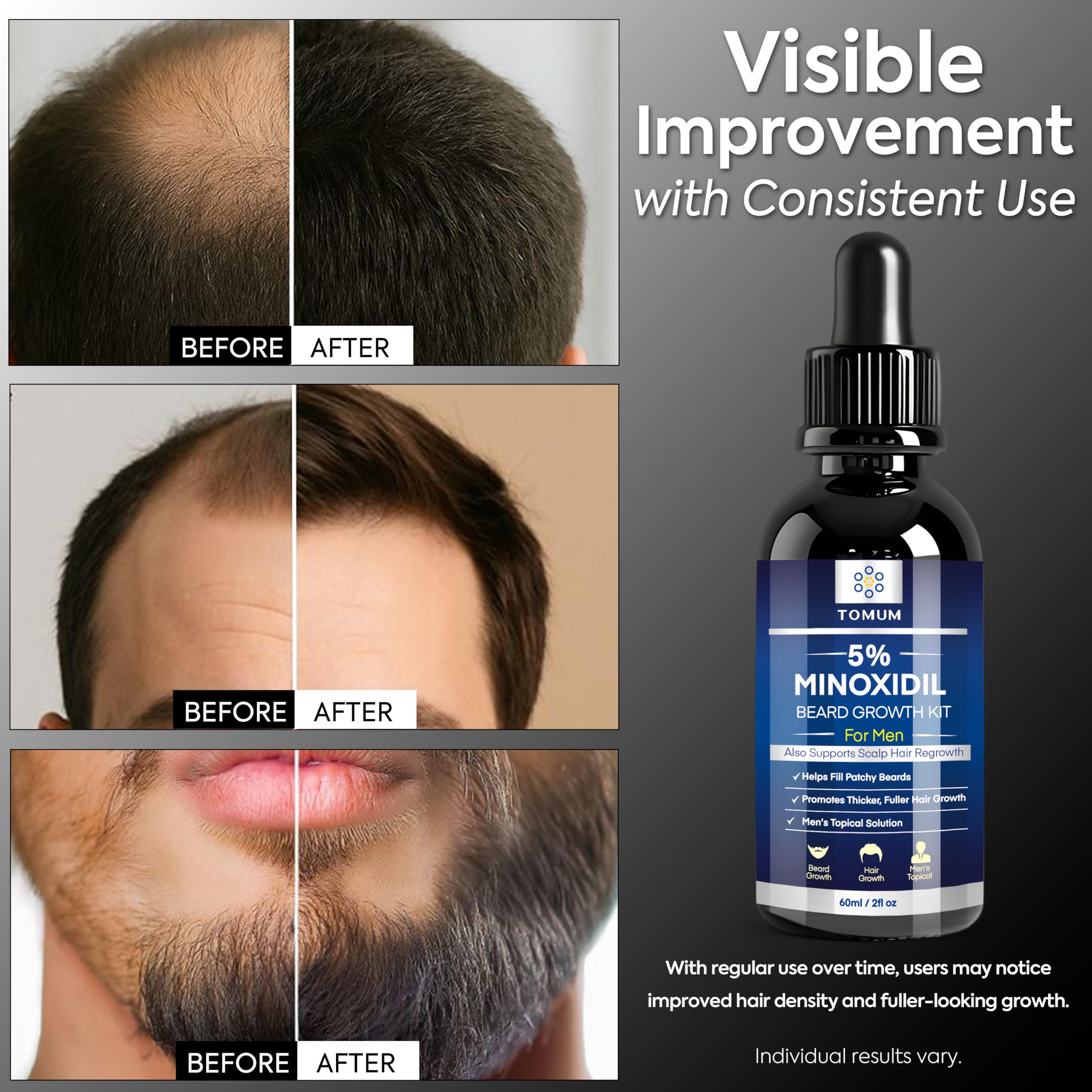 TOMUM aplicando el suero en la barba para rellenar zonas despobladas